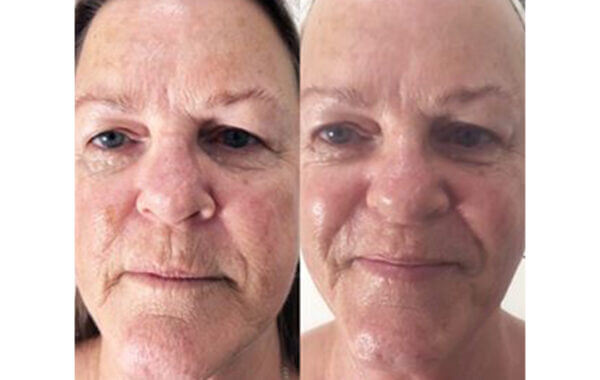 anti-aging gezichtsbehandeling