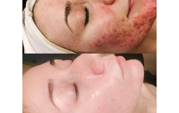 acne behandeling